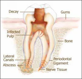 Tooth disease indicating a root canal