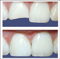 Composite Bonding Before After