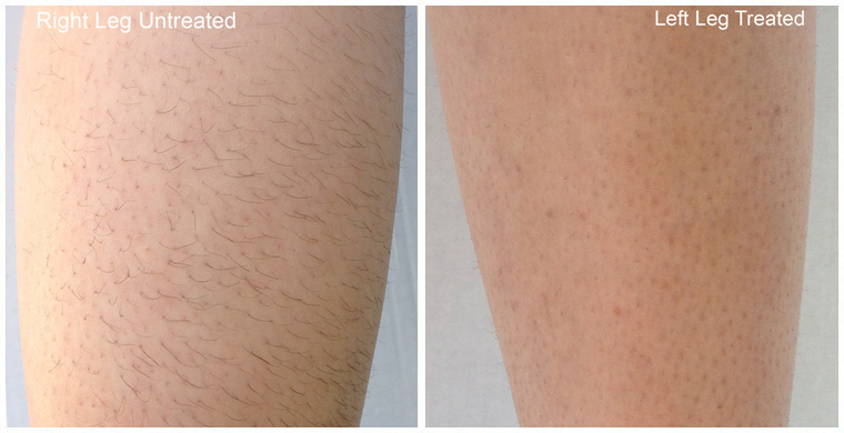 Diolaze Laser Hair Removal After 6 Treatments