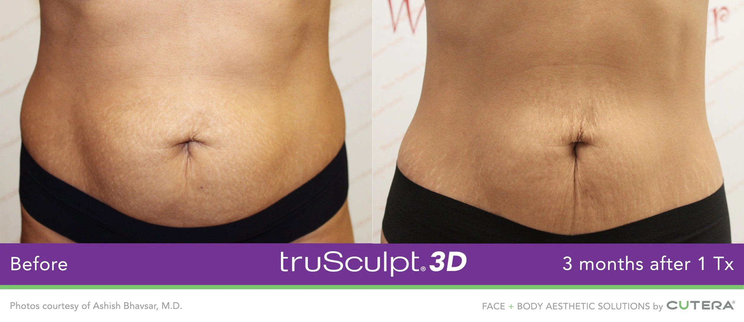 truSculpt-3D-B-A-Image-12.jpg
