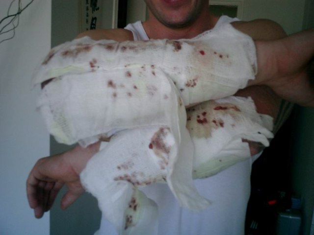 The day after my second treatment after removing the compression bandages.