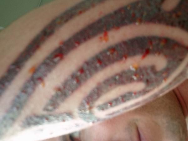The post-laser "sweating" that would take place for about a week after treatment.