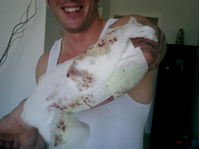 You can see how much lighter the elbow is just two sessions later.