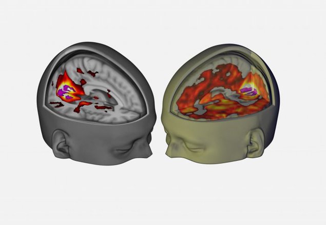 The areas that contributed to vision were more active under LSD (right), revealing a more “unified” brain. Picture courtesy of the Beckley Foundation.