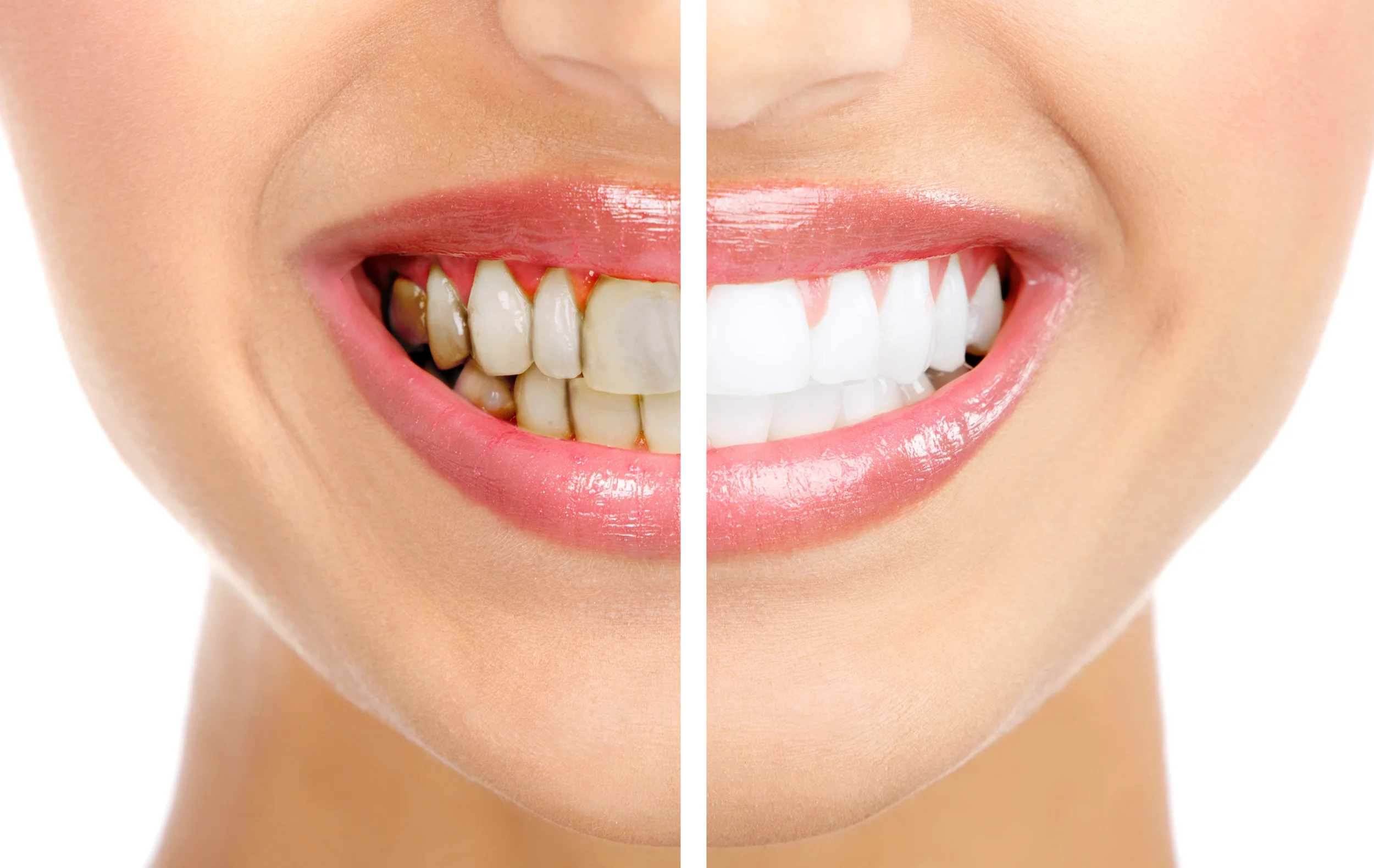 teeth whitening