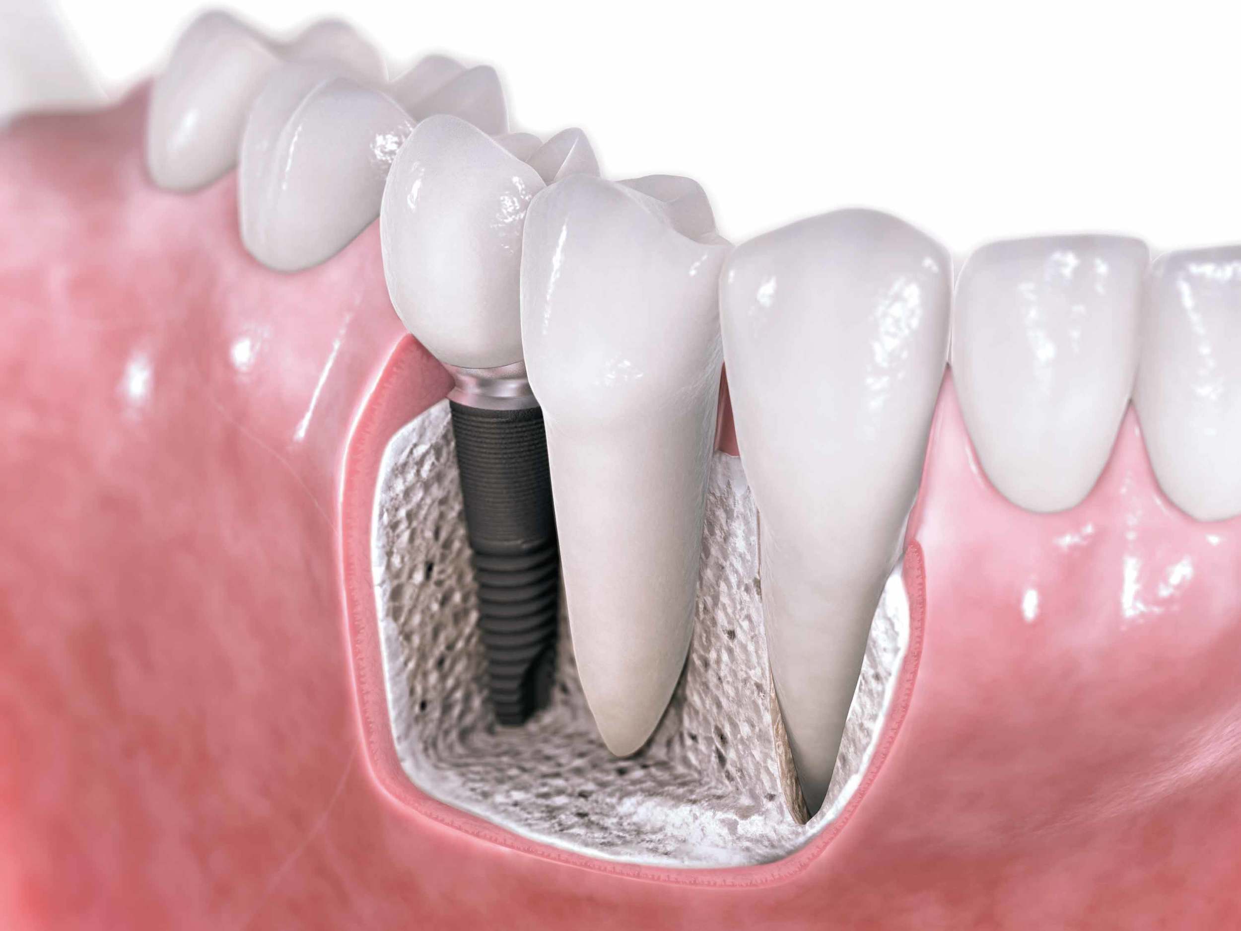 implant dentistry