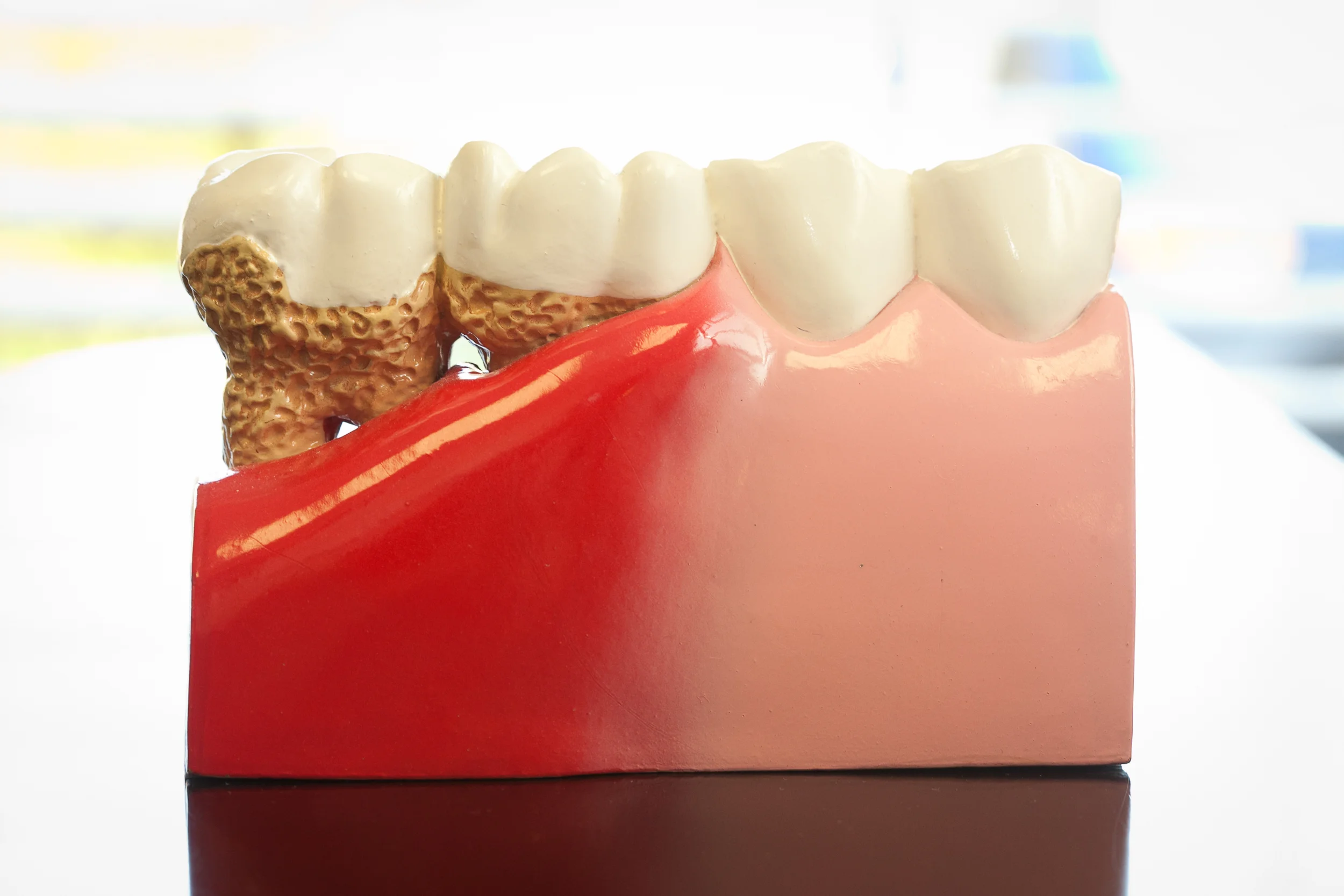 periodontal disease