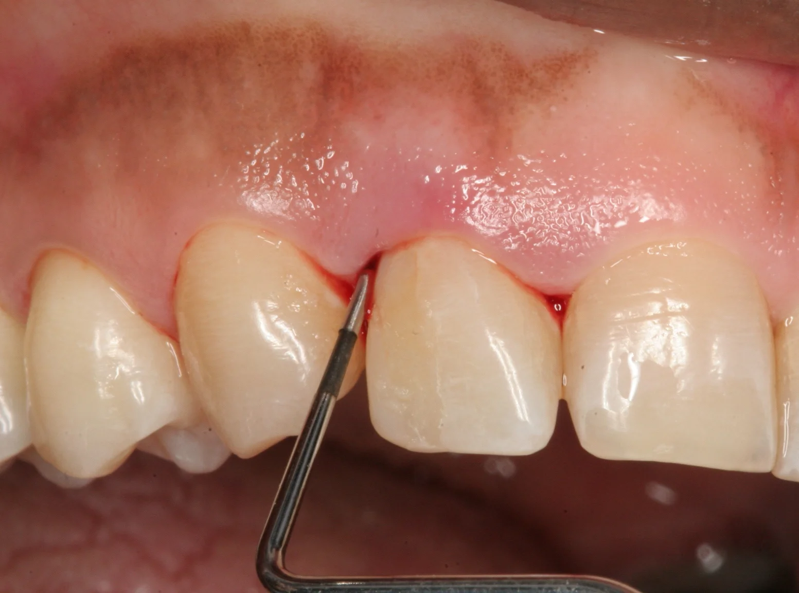 periodontal disease