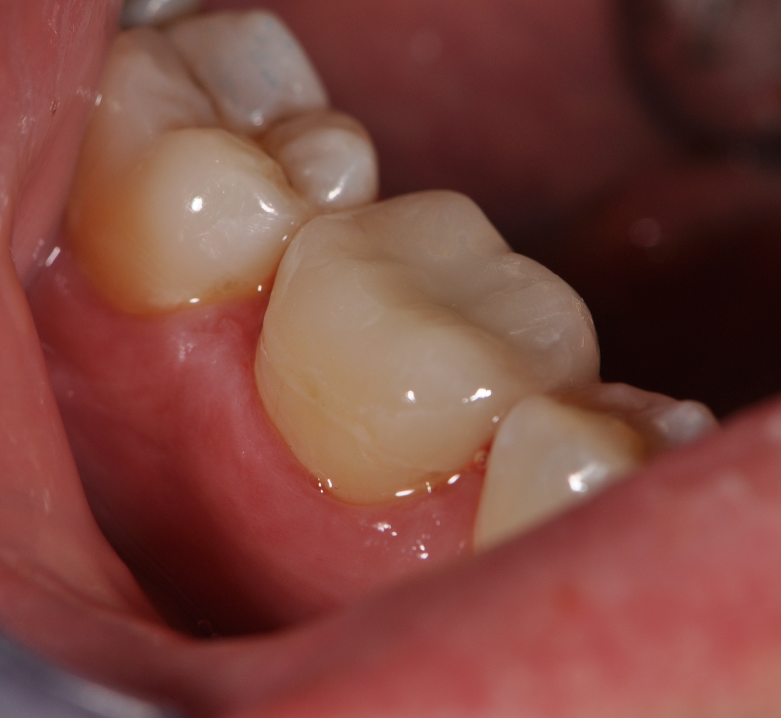 restorations and fillings