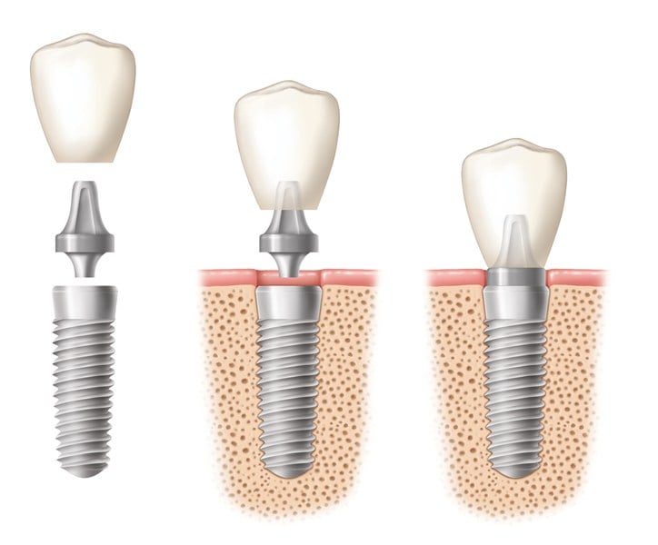 implant dentistry