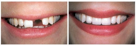 implant dentistry before and after