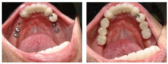 implant dentistry before and after