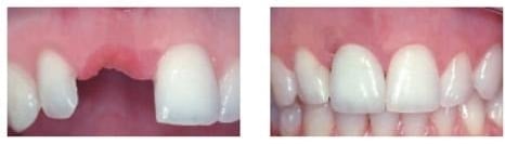 implant dentistry before and after