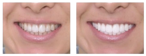 teeth whitening before and after