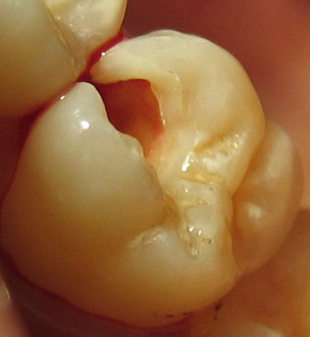 restorations and fillings