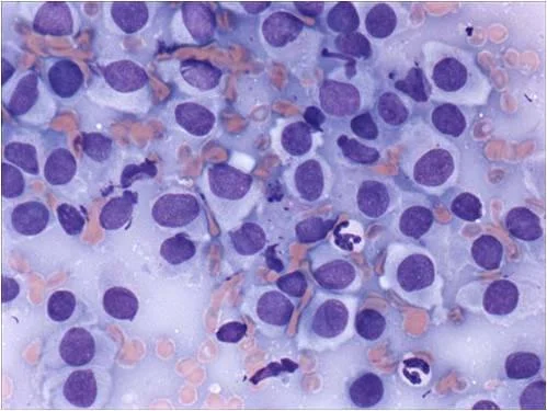  Typical appearance of a histiocytoma cytology.