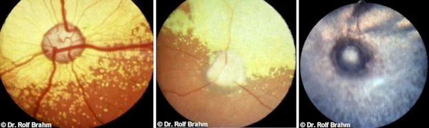 Left image is a normal retina. Middle image is mid-stage PRA. Right image is end stage PRA. Note the near total lack of blood vessels visible. 
