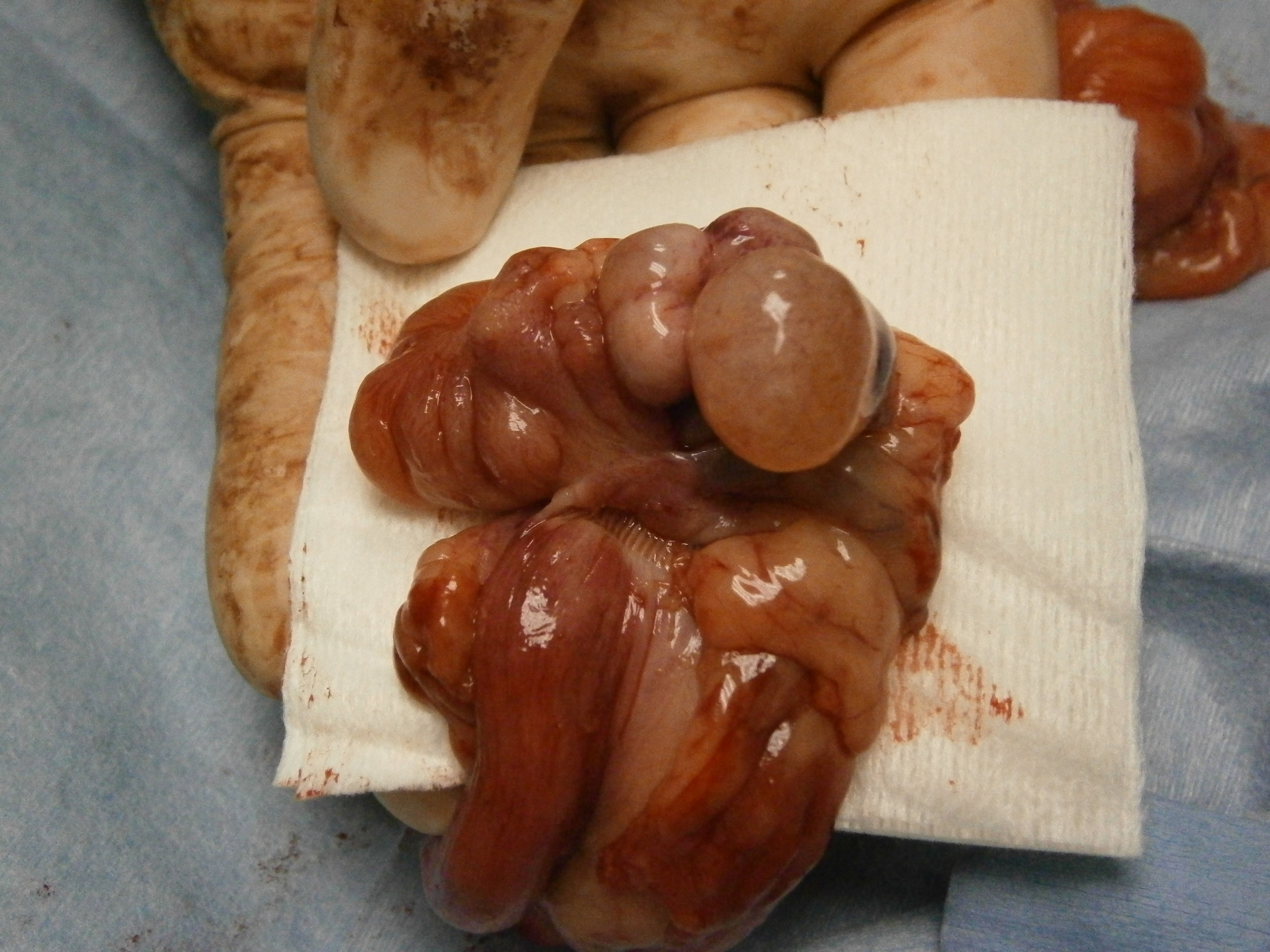 This is an ovary with many large cysts present. The ovary proper is the light pink structure between my middle and ring fingers.