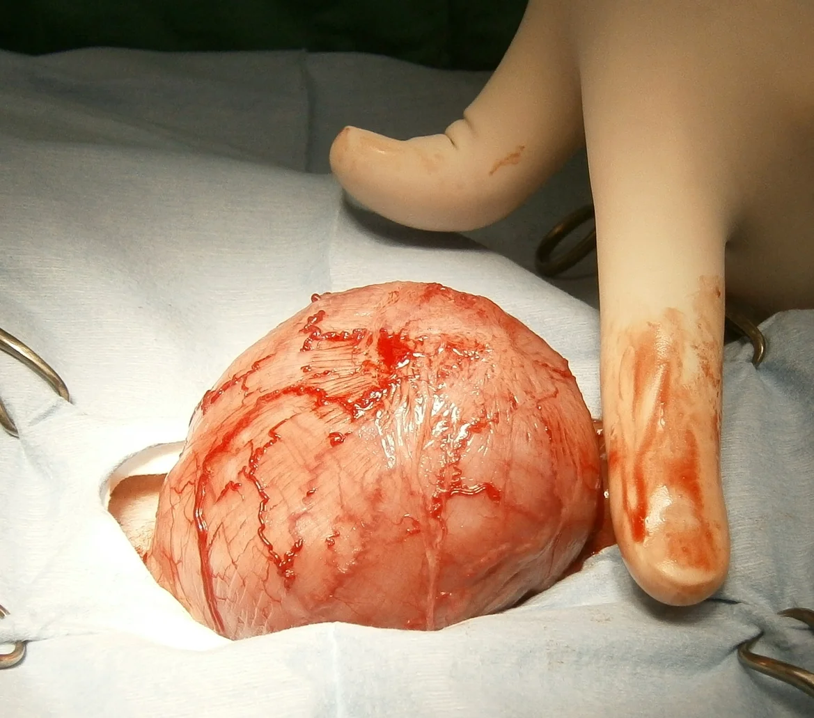 Intra-operative picture of the outside of the bladder. It felt like holding a bean bag.