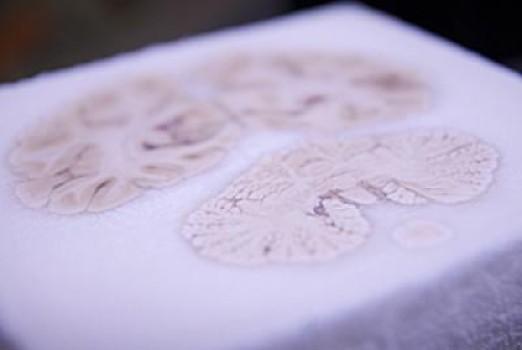 HM's Brain. Credit: UC San Diego School of Medicine