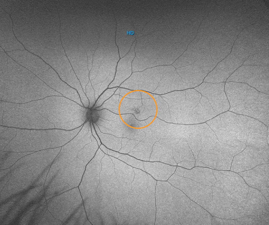 Stonewire Optometry UltraWidefield Digital Retinal Imaging Eye Exam
