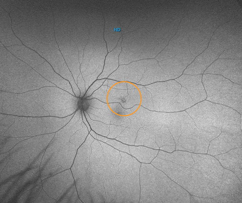 Stonewire Optometry | Ultra-Widefield Digital Retinal Imaging Eye Exam
