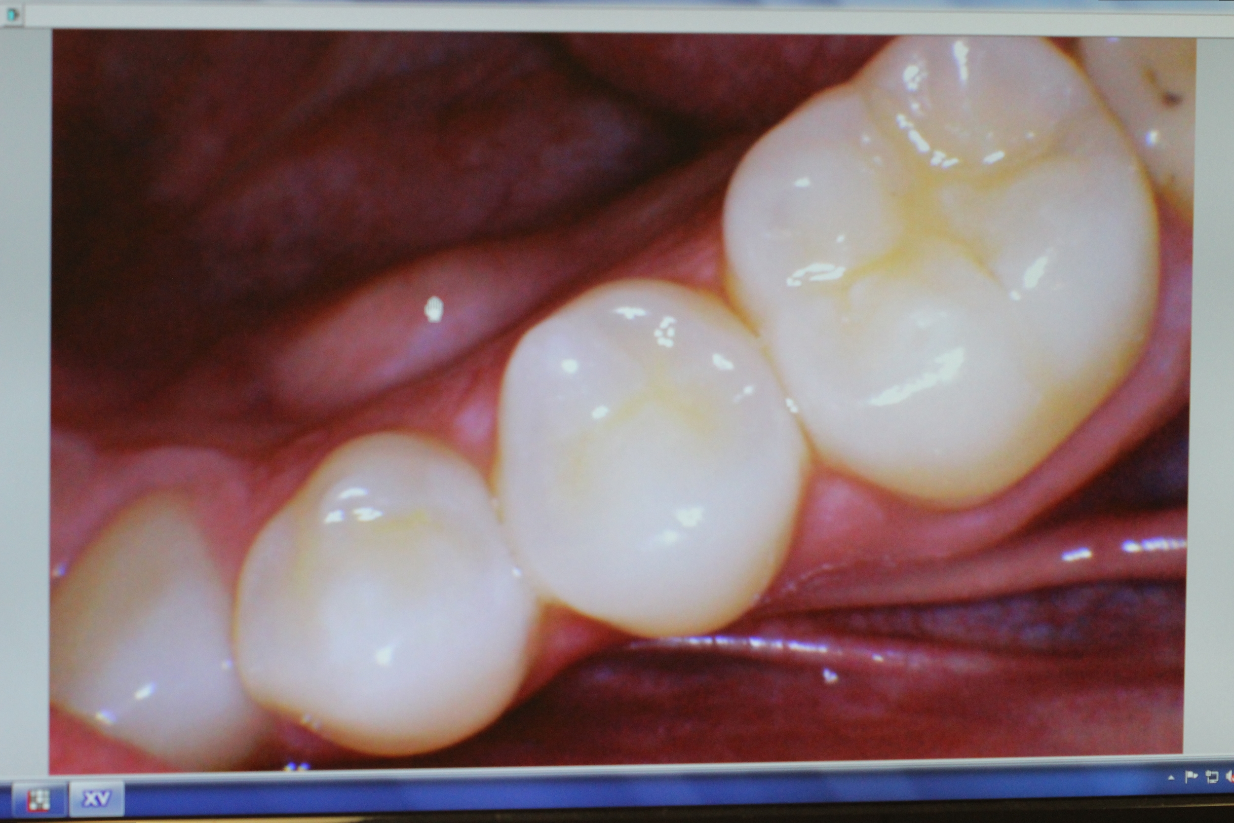 Intraoral Dental Photos