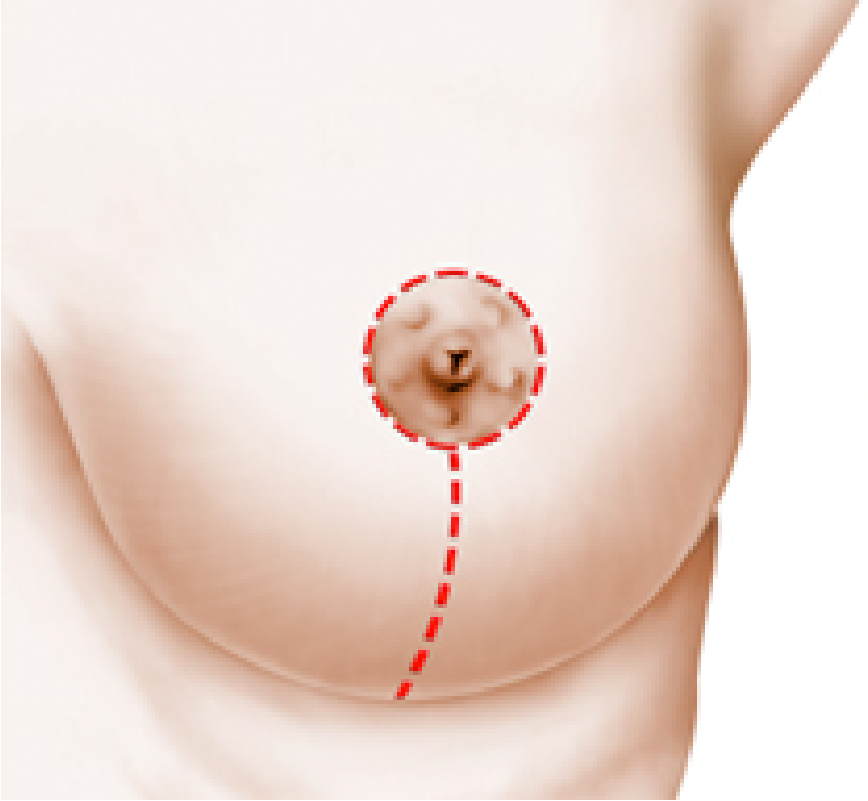 Can withstand Final storm Breast Lift, Fort Worth, TX — West Magnolia Plastic Surgery