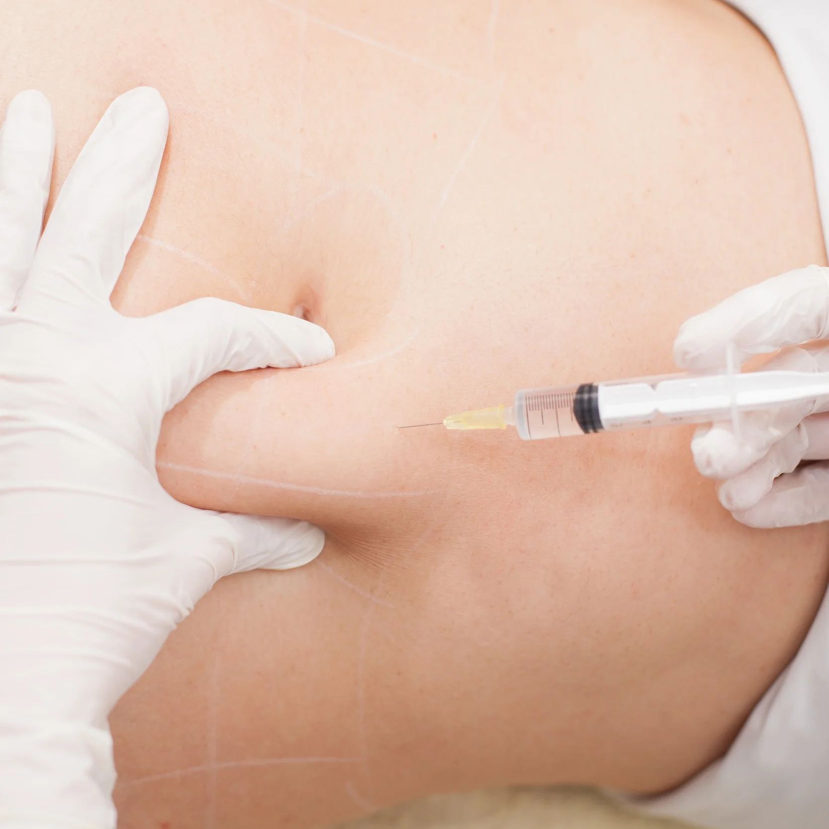 Fat transfers, Fort Worth