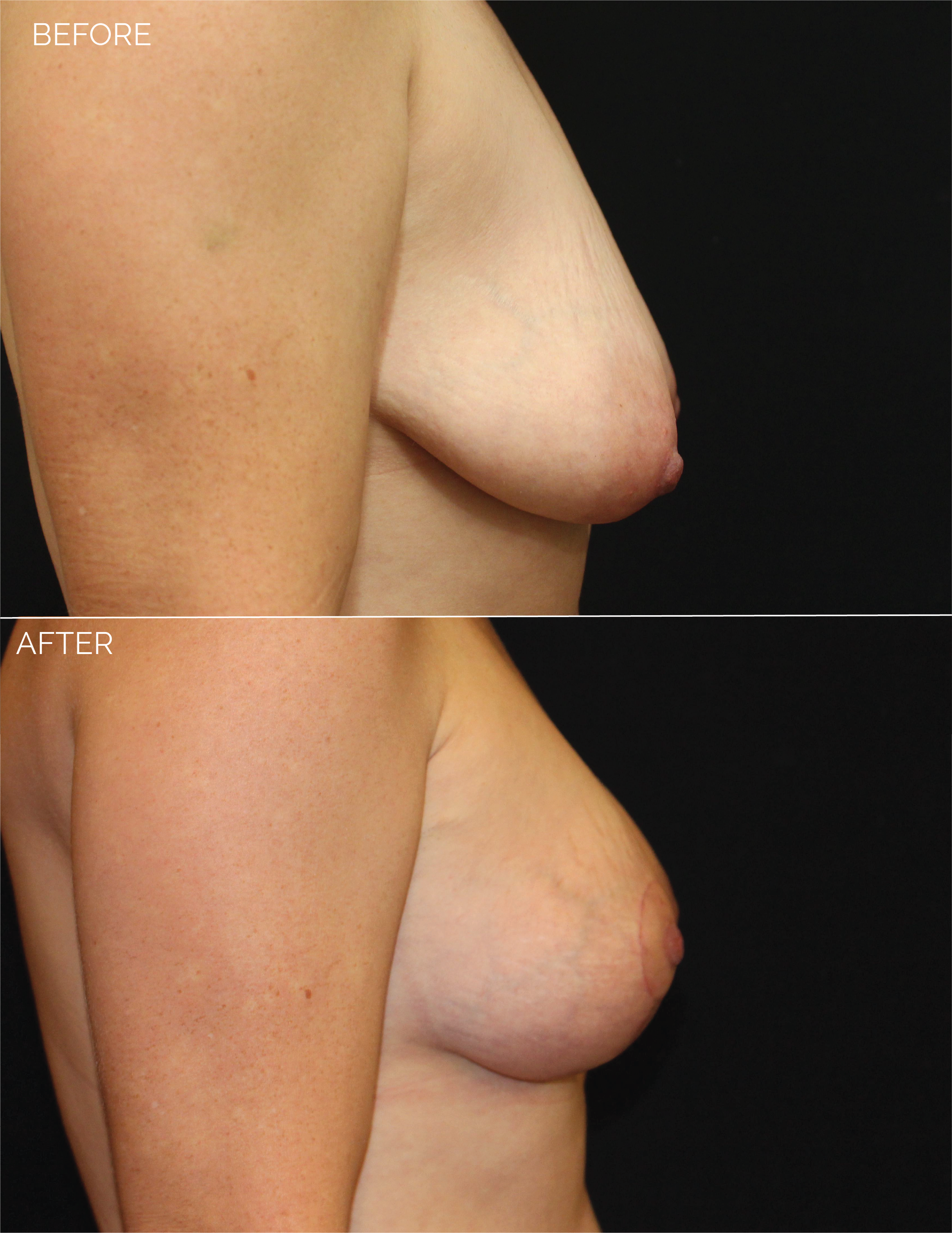 BREAST AUGMENTATION  + VERTICAL MASTOPEXY - CHART #5037-10.png