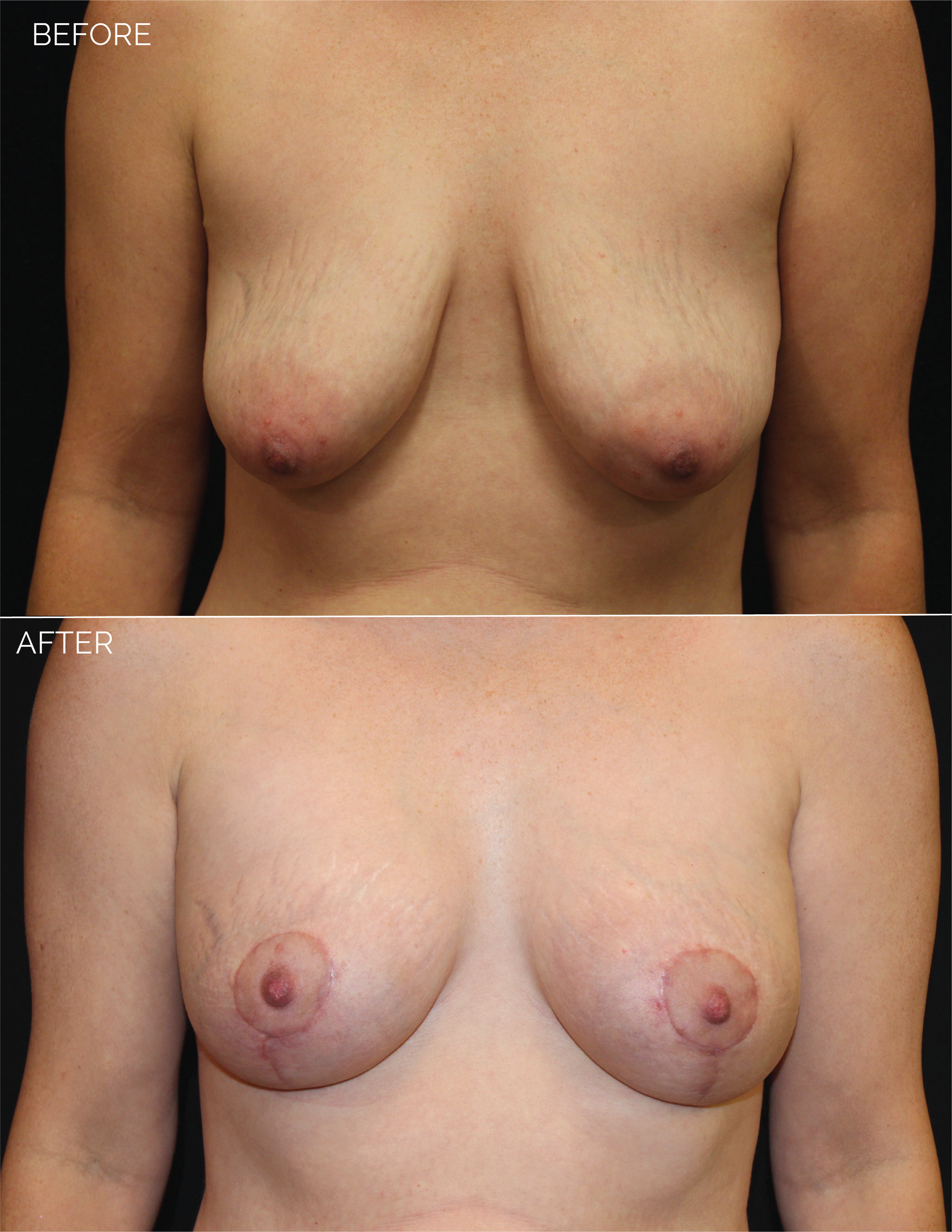 BREAST AUGMENTATION  + VERTICAL MASTOPEXY - CHART #5037-06.png