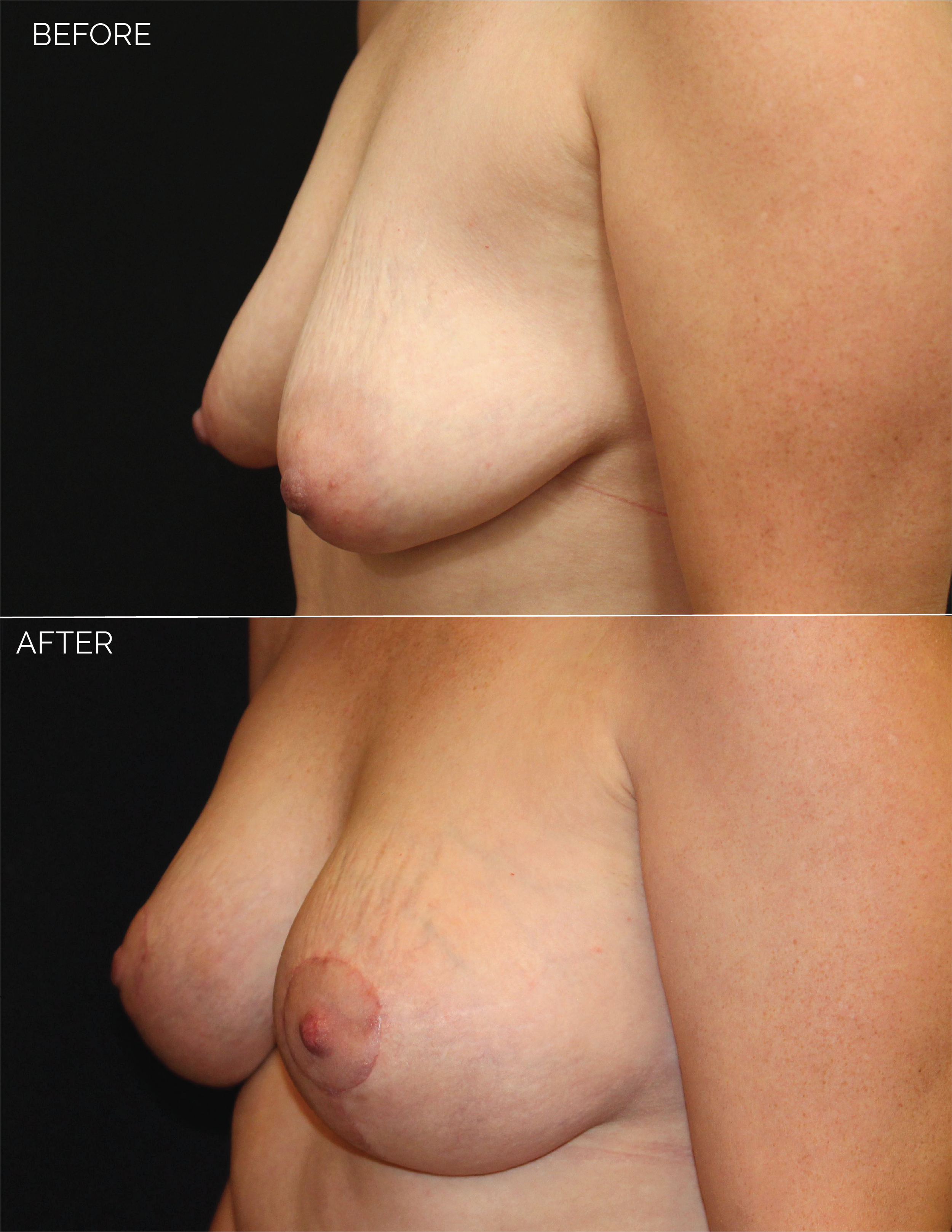 BREAST AUGMENTATION  + VERTICAL MASTOPEXY - CHART #5037-07.png