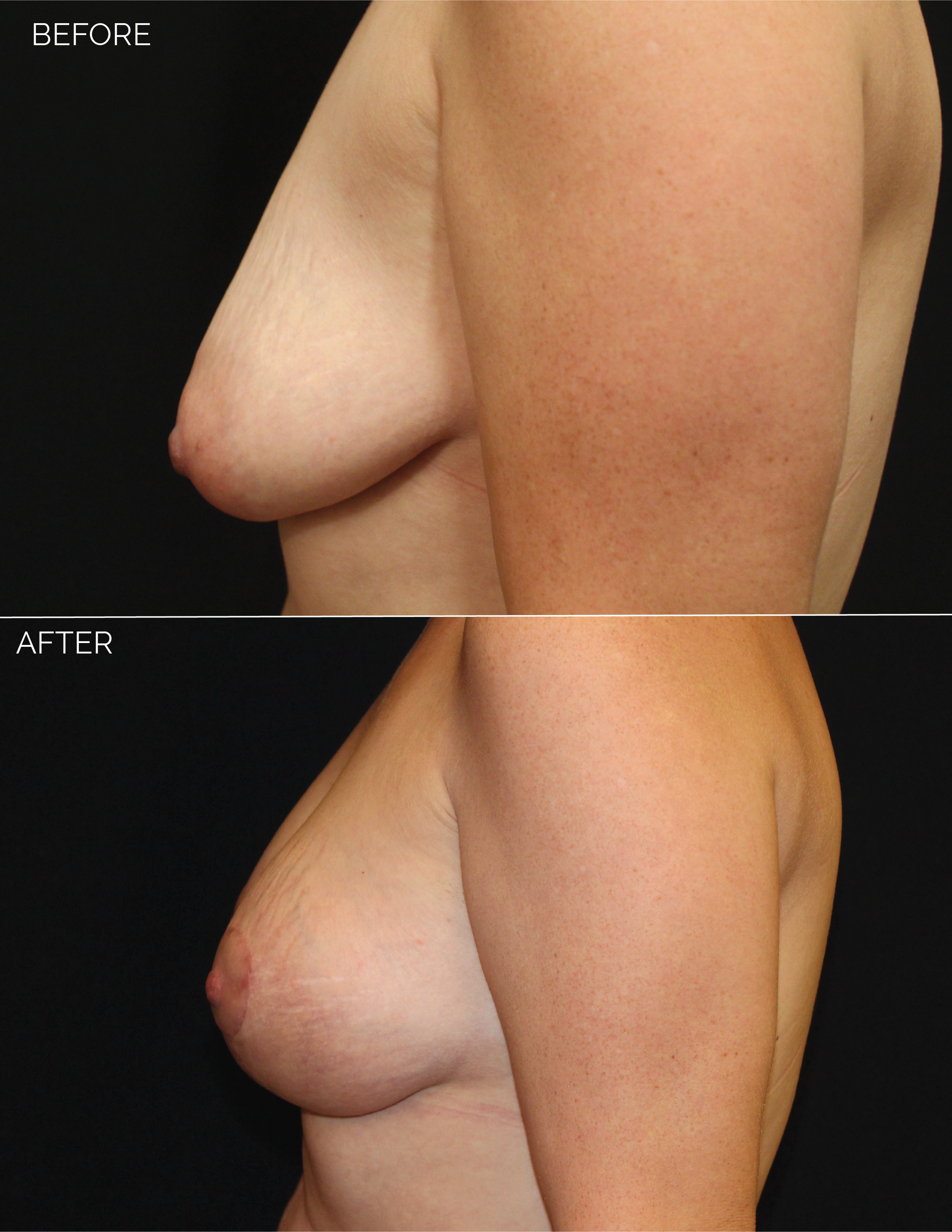 BREAST AUGMENTATION + VERTICAL MASTOPEXY - CHART #5037-08.png
