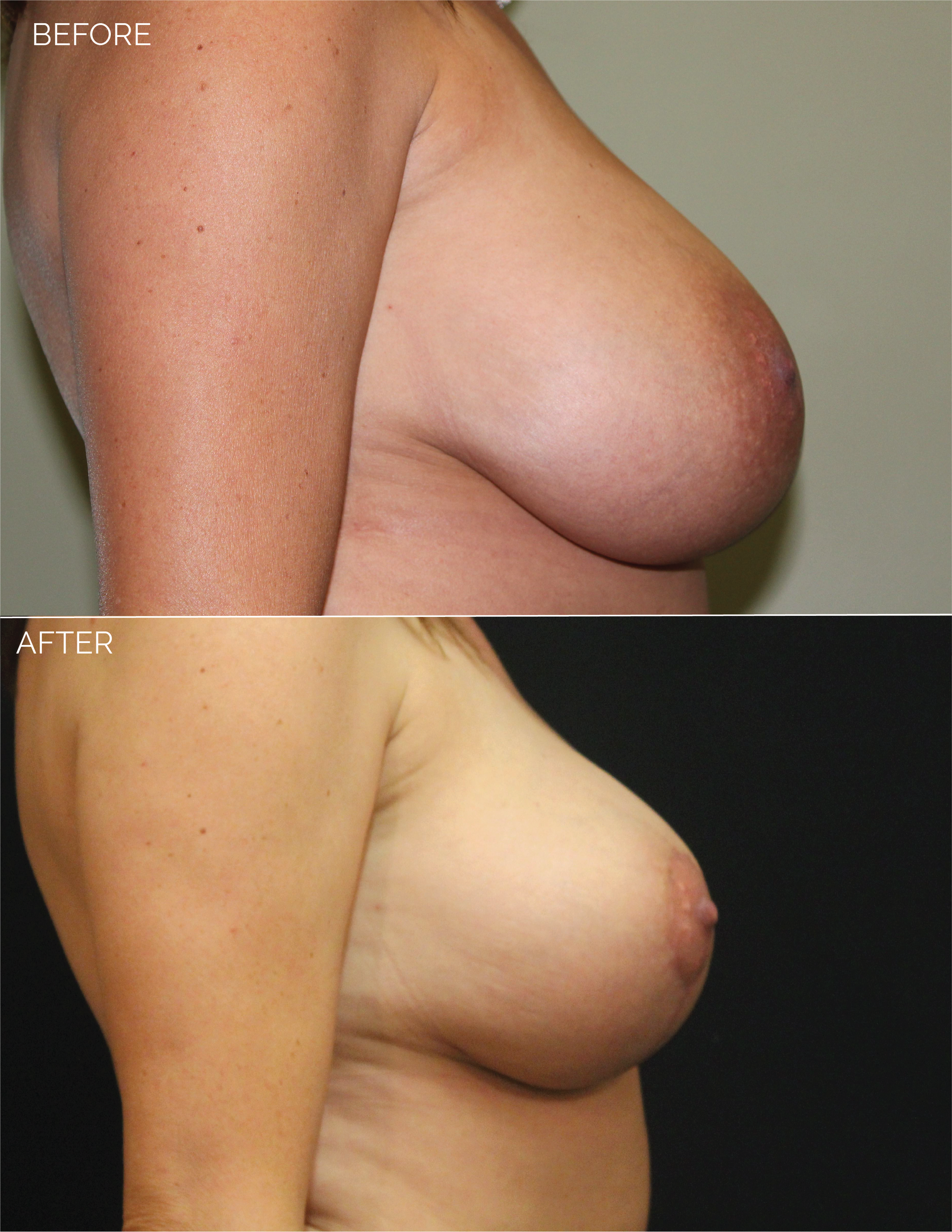 BREAST LIFT - CHART #4400 - 1 MONTH POST OP-10.png