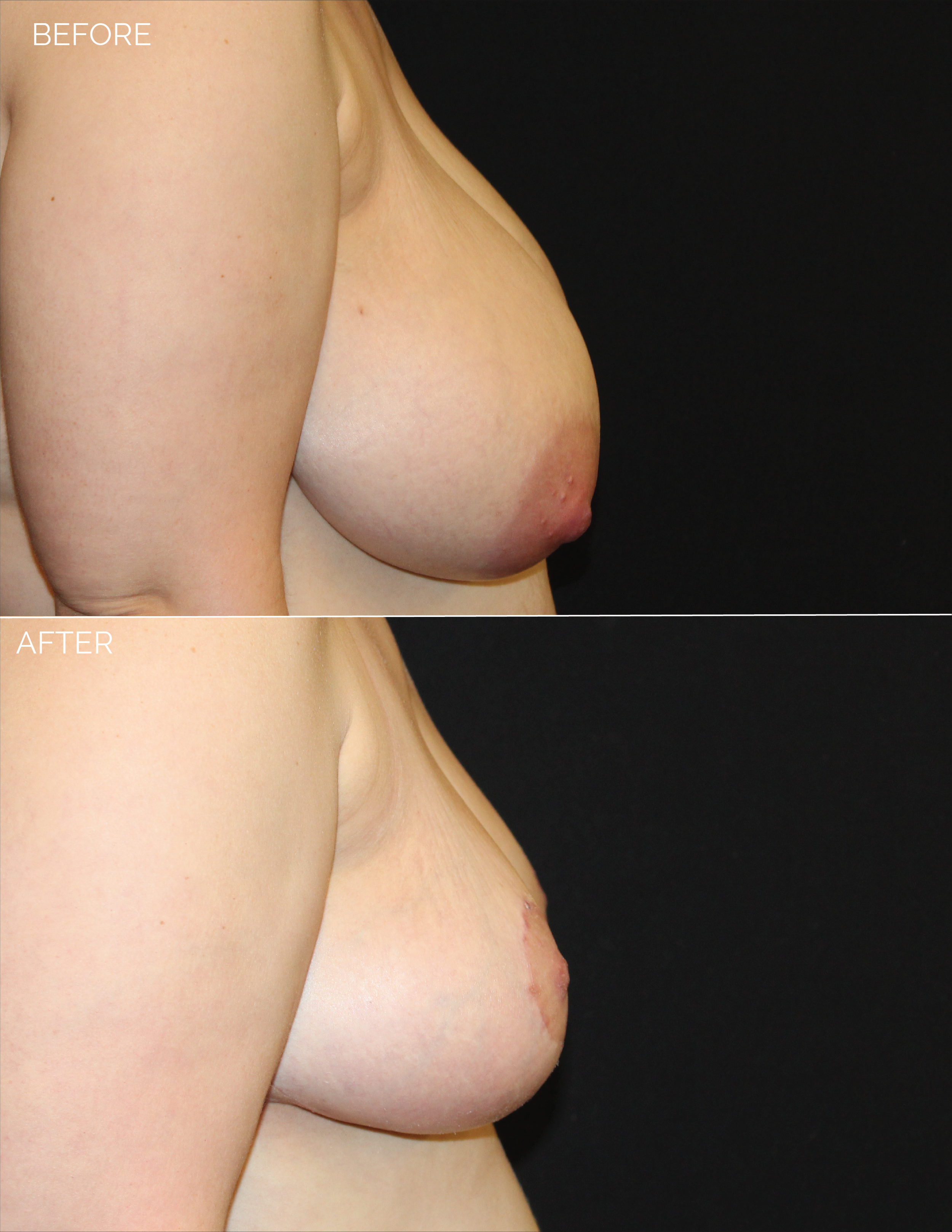 3447 A.F. Breast Reduction-06.png