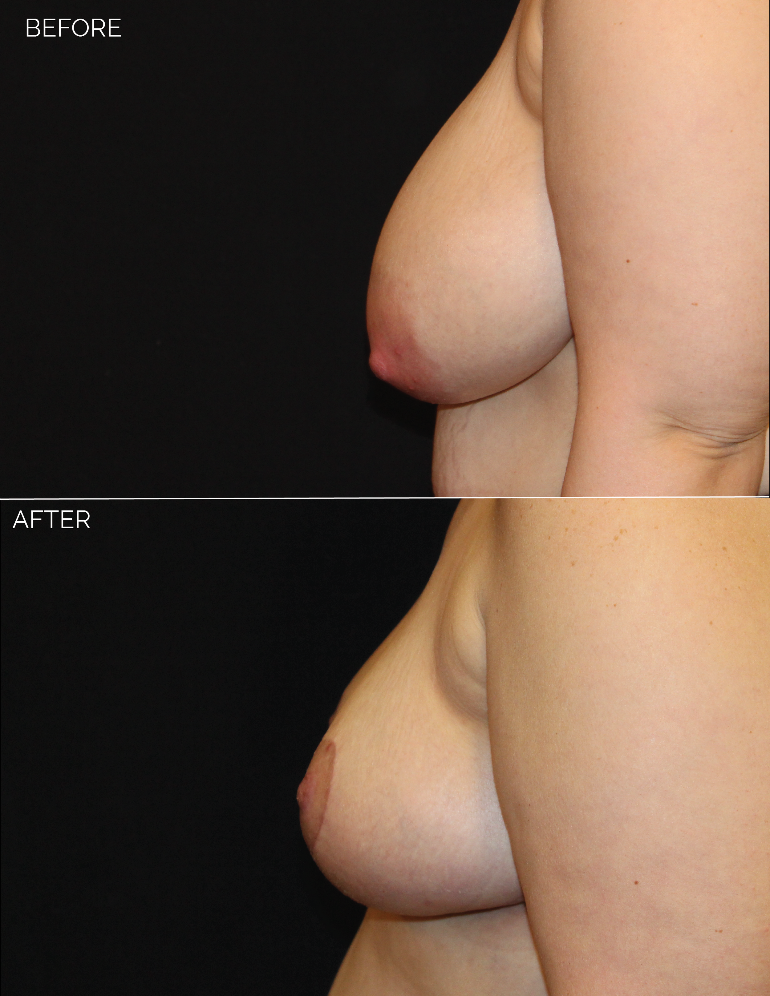 3447 A.F. Breast Reduction 0-05.png