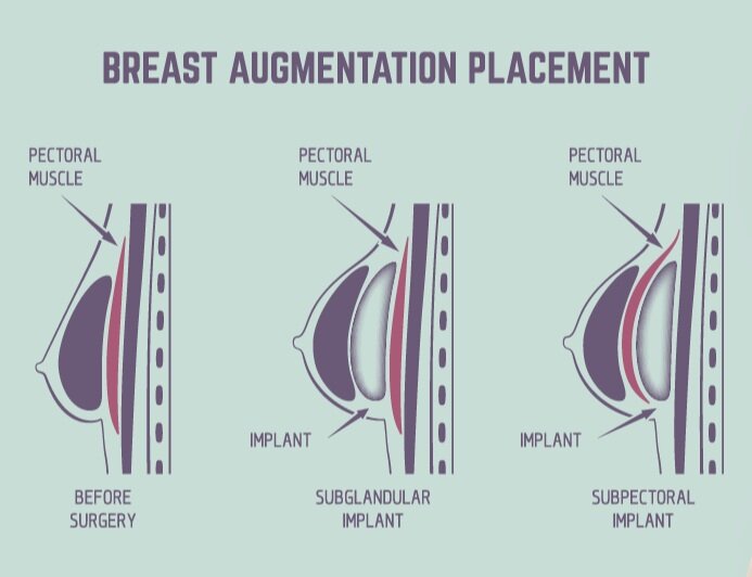 Breast Implant Surgery: Breast Implants Under The Muscle