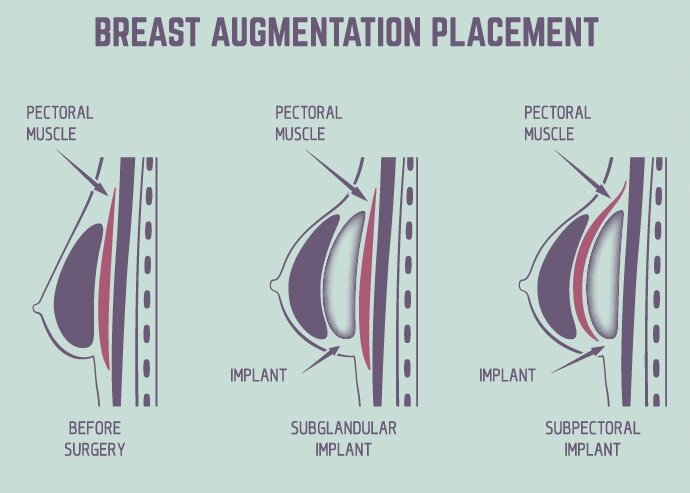 Southern Station Southeast Breast Augmentation, Fort Worth, TX — West Magnolia Plastic Surgery