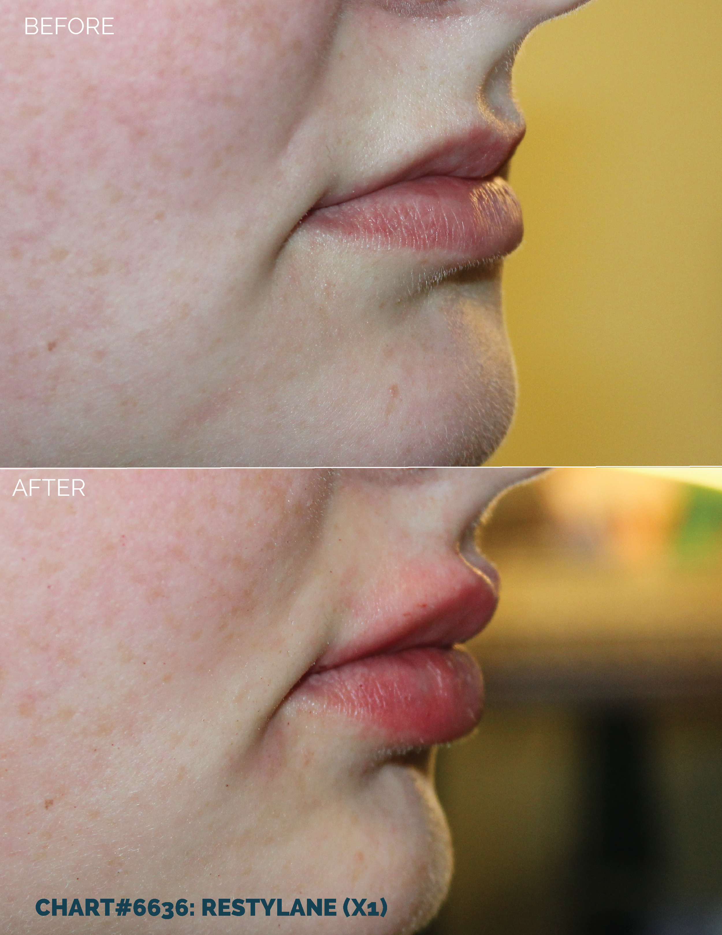 LIPS FILLER_CHART#6636- RESTYLANE (X1) copy.png