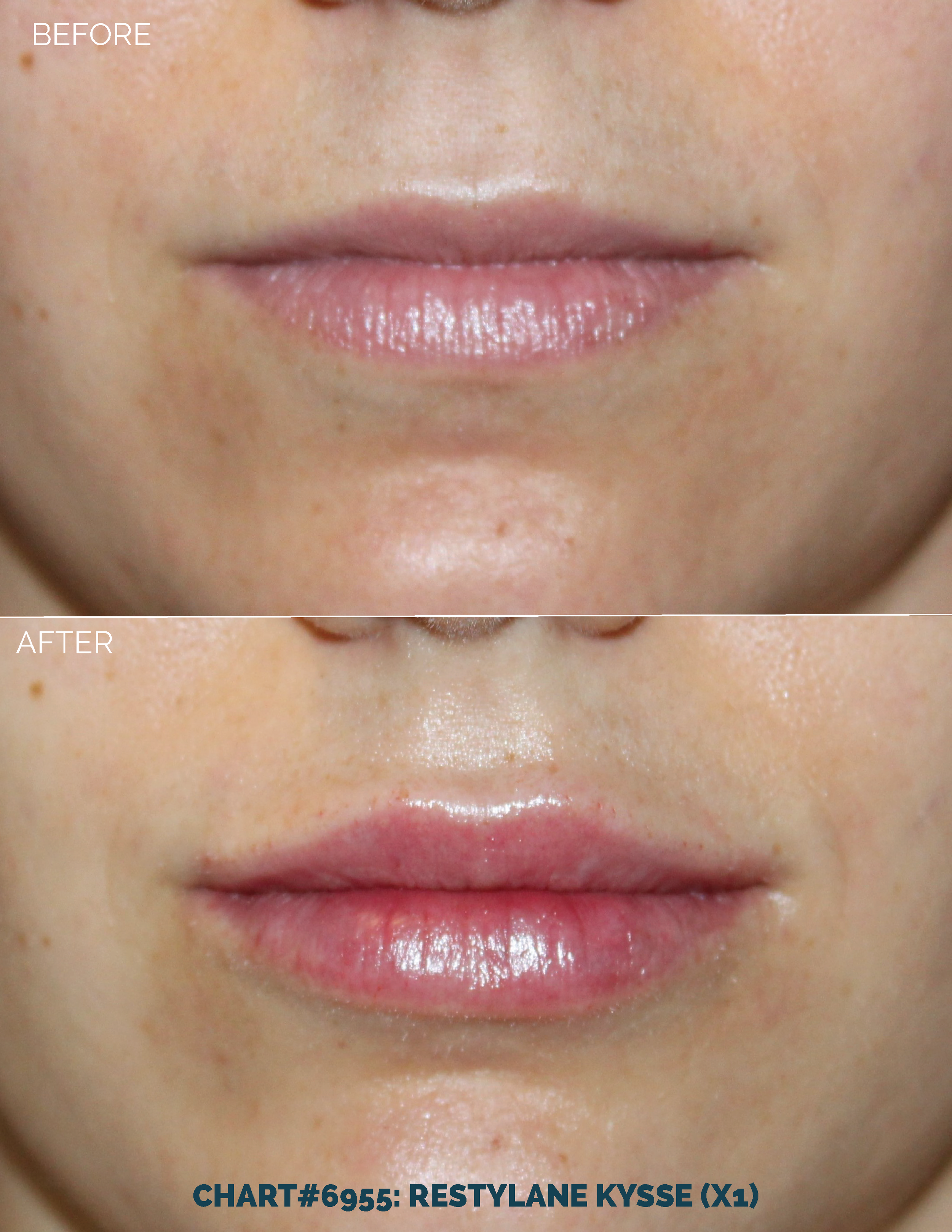 LIPS FILLER_CHART#6955- RESTYLANE KYSSE (X1).png