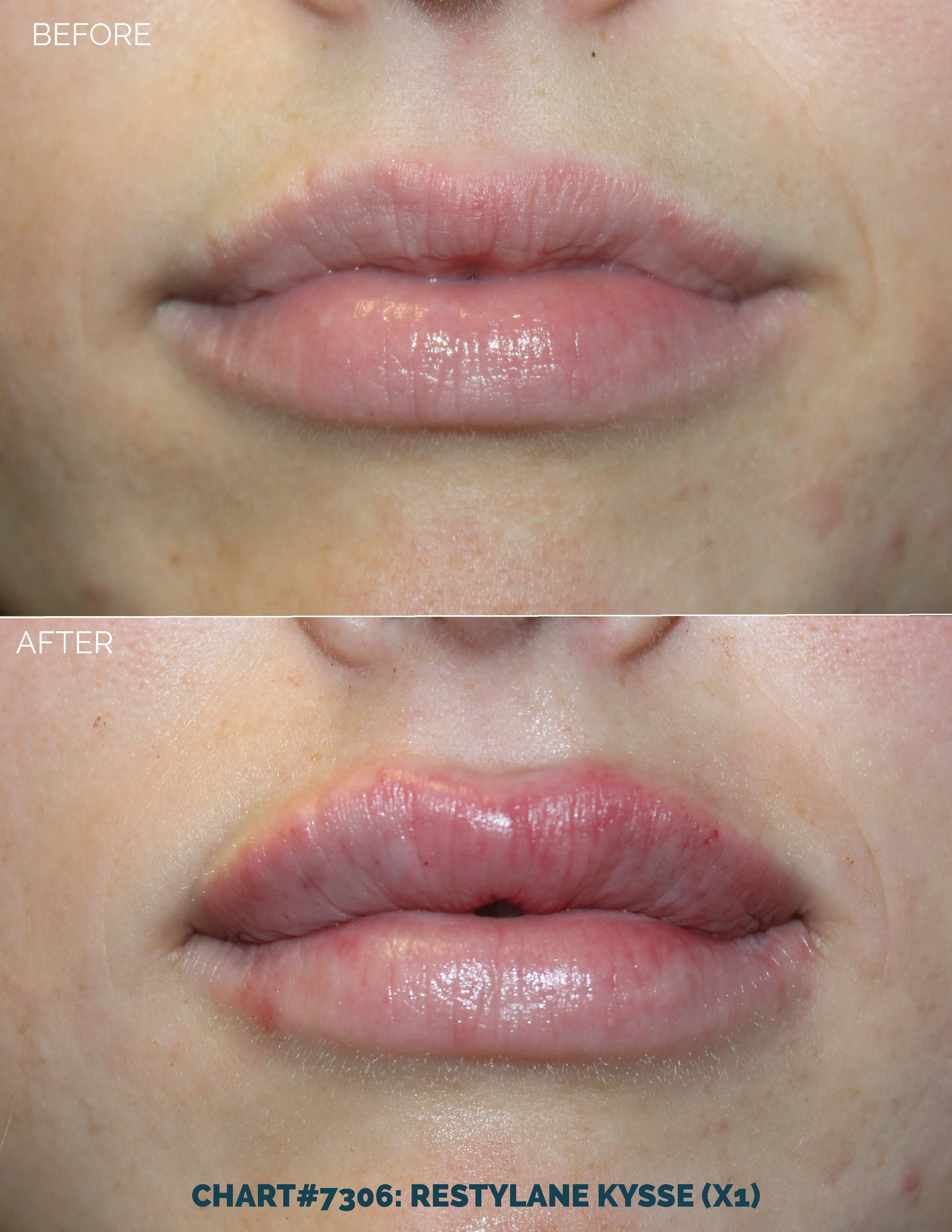 LIPS FILLER_CHART#7306- RESTYLANE KYSSE (X1).png