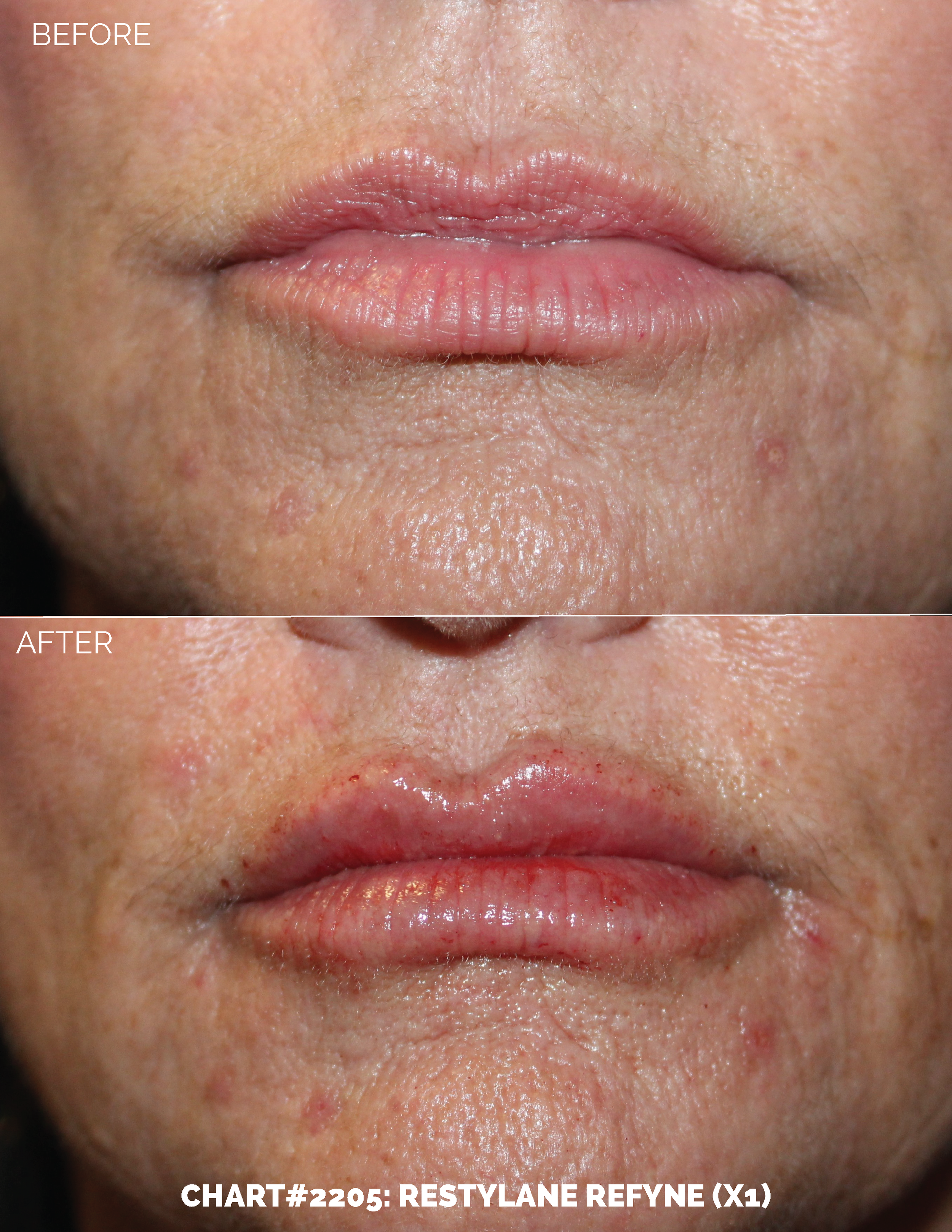 LIPS FILLER_CHART#2205- RESTYLANE REFYNE (X1).png