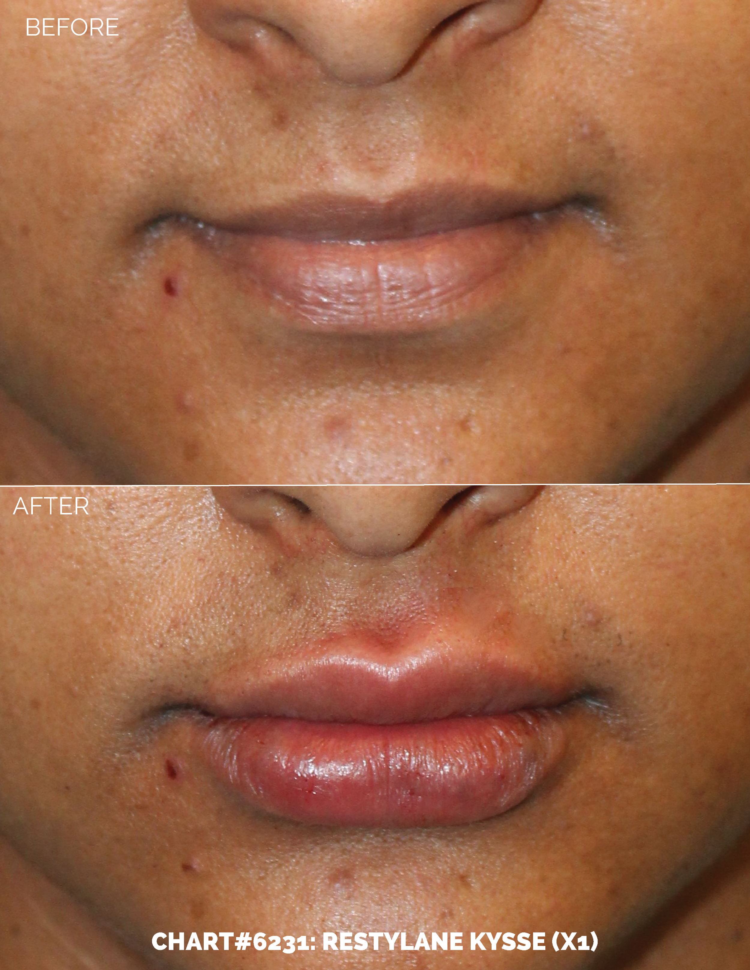 LIPS FILLER_CHART#6231- RESTYLANE KYSSE (X1).png