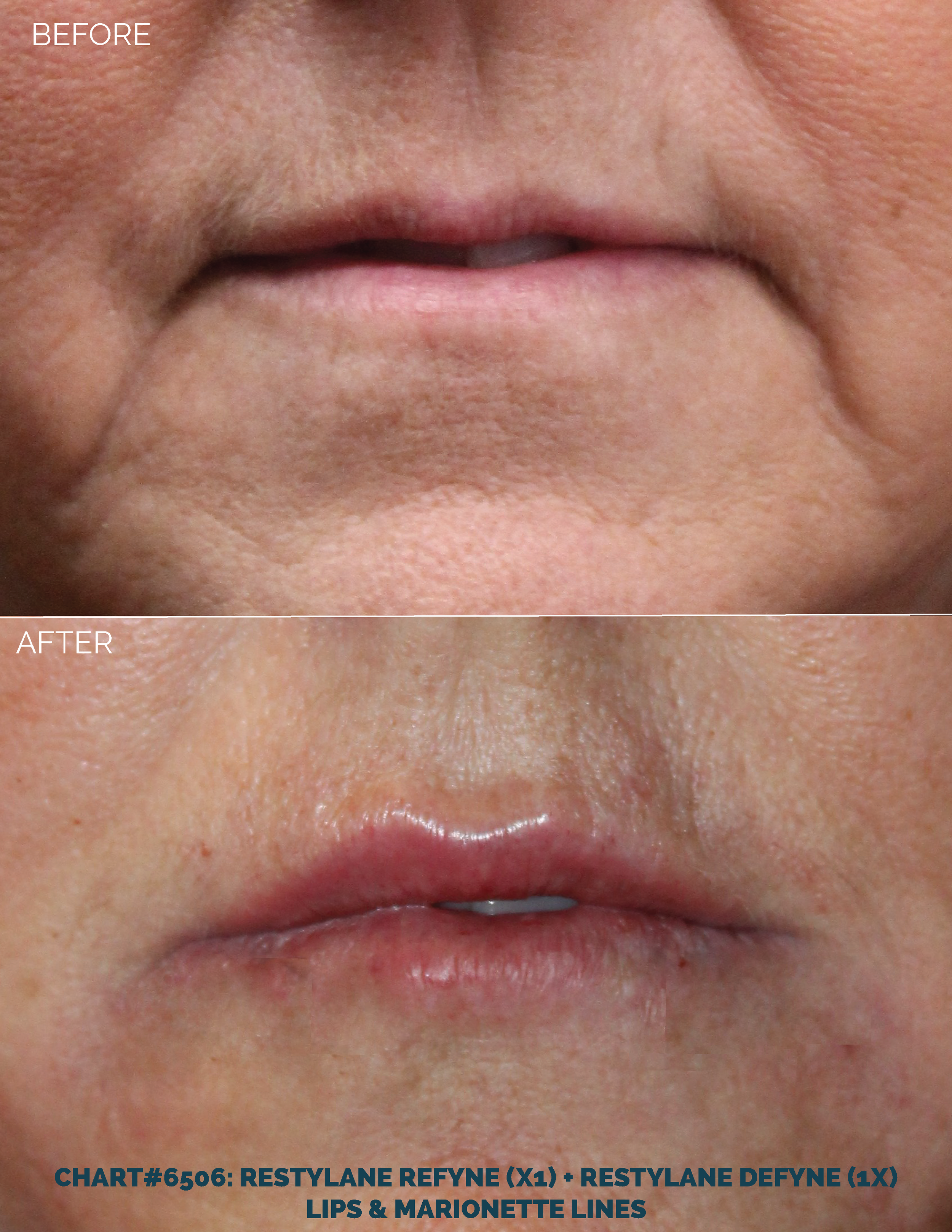 LIPS FILLER_CHART#6506- RESTYLANE REFYNE (X1) + RESTYLANE DEFYNE (1X).png