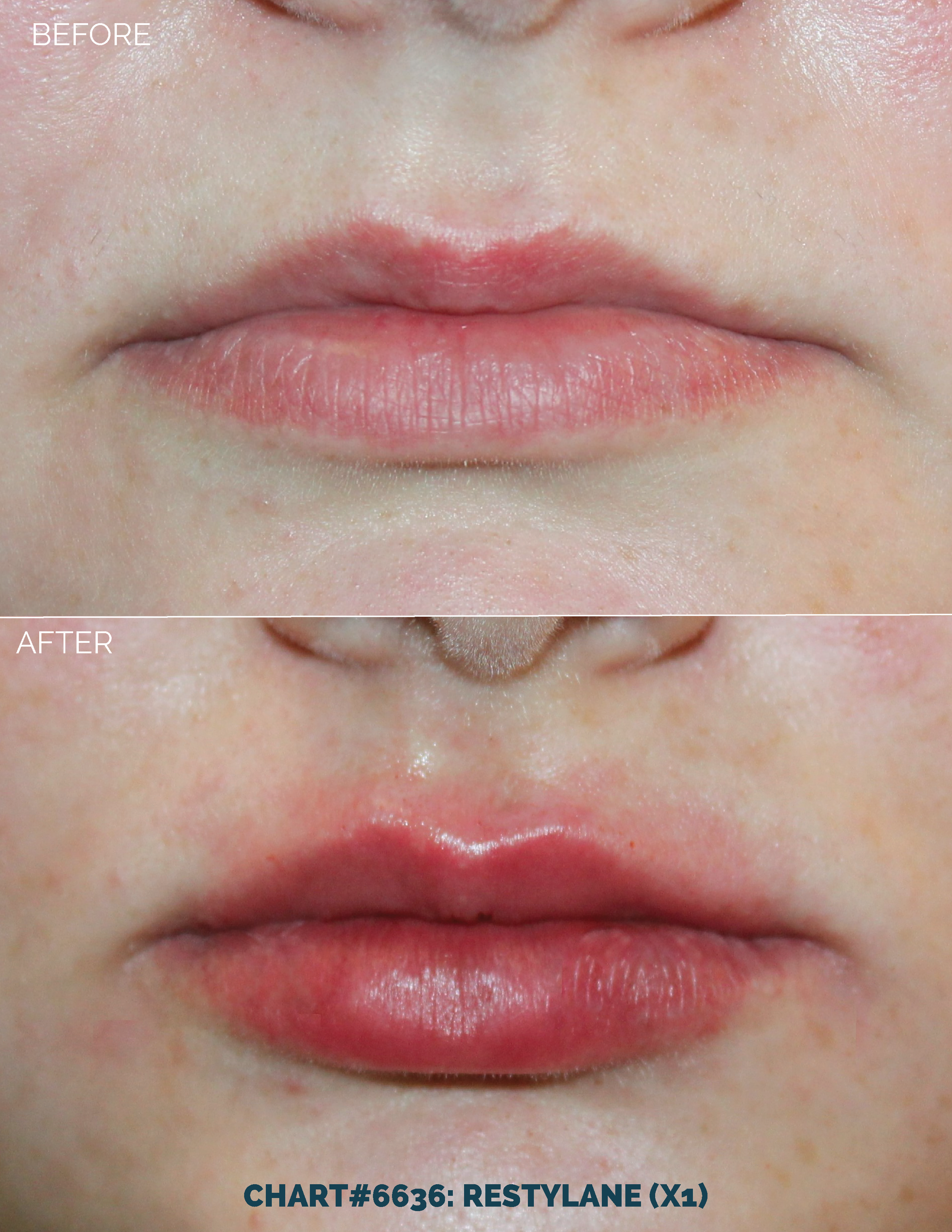 LIPS FILLER_CHART#6636- RESTYLANE (X1).png