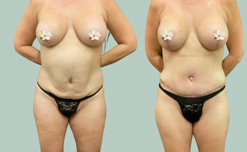 Tummy tuck results from board-certified plastic surgeon in Fort Worth