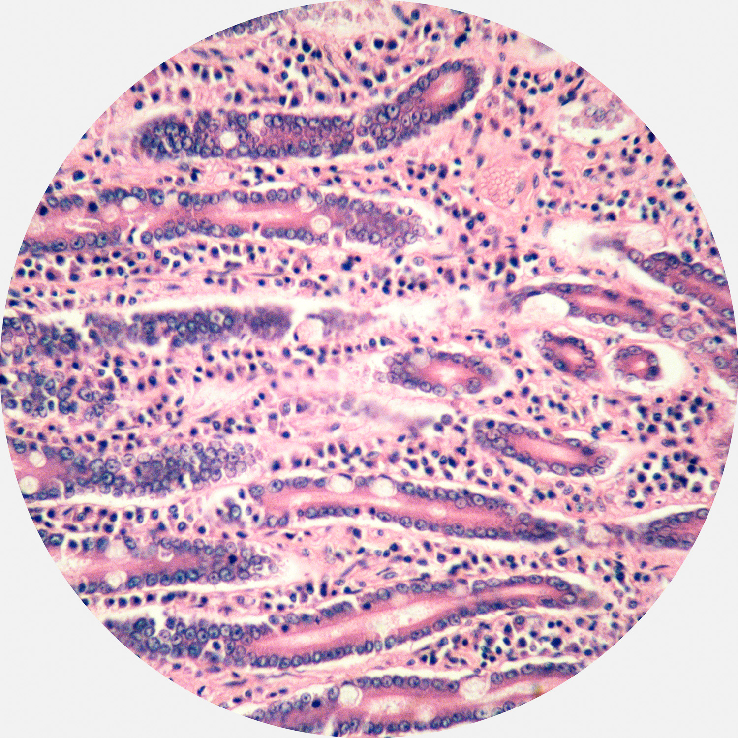   Pancreatic Glandular Tissue  