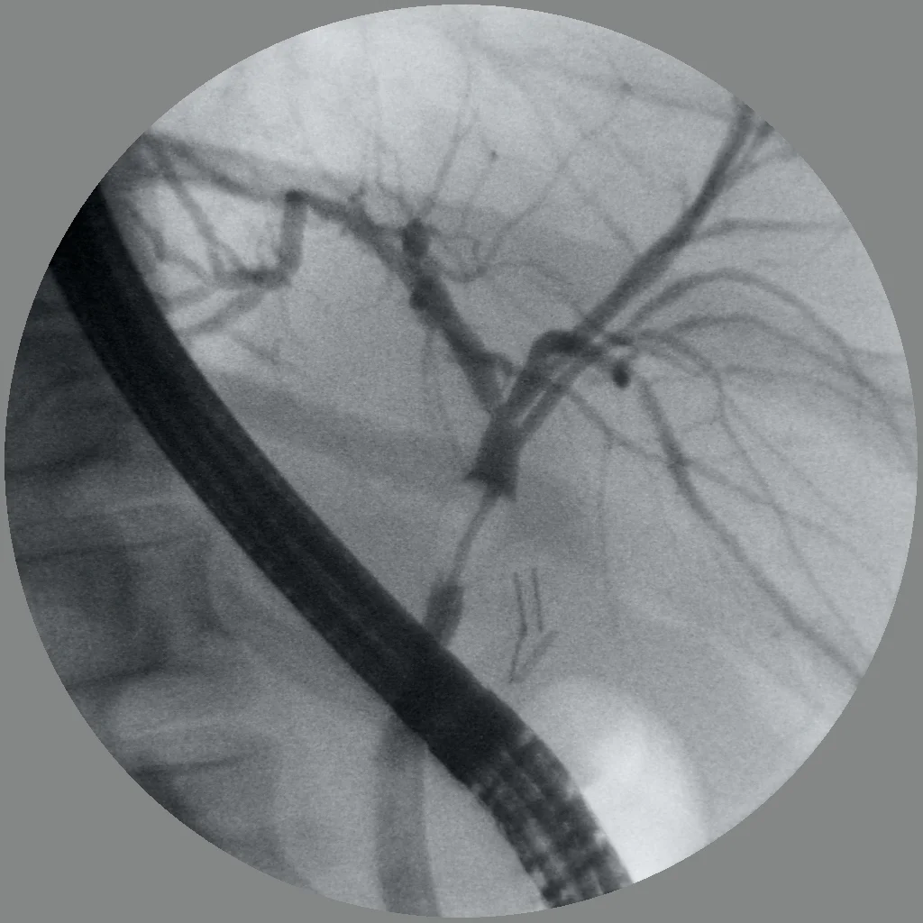 Endoscopy as NET Diagnostic Tool 