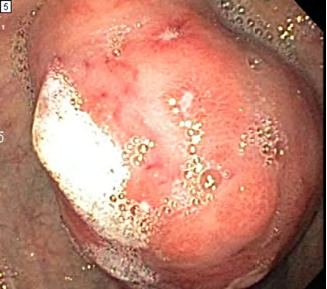 Image from upper endoscopy, demonstrating a large gastric NET with overlying ulceration.