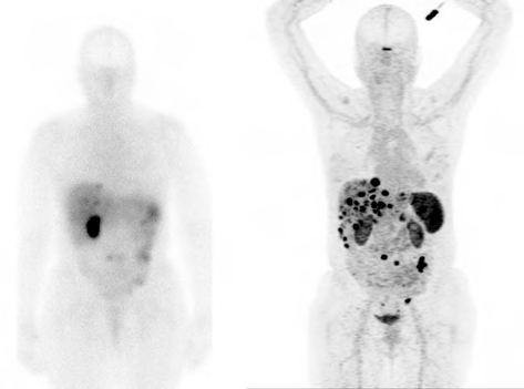 A comparison in the same patient between a In111-pentetreotide scan (OctreoScan, left) and Ga68-DOTATATE PET (NetSpot, right). Images courtesy of Hong Song, MD, PhD (Stanford University).